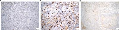 High PD-L1 expression on immune cells along with increased density of tumor-infiltrating lymphocytes predicts a favorable survival outcome for patients with loco-regionally advanced head and neck cancer: early results from a prospective study